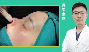 仿生鼻整形案例【视频】