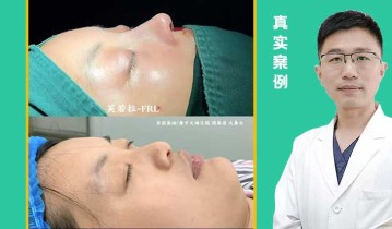 自体肋骨鼻综合即刻效果视频