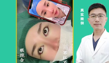 眼综合四项