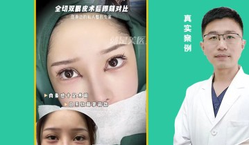 全切双眼皮术后即可对比