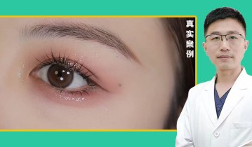 张亚伦医生-眼综合双眼皮效果
