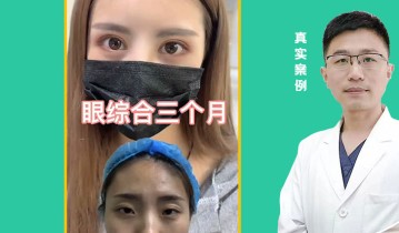 眼综合3个月效果
