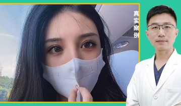 张亚伦医生-黄金媚眼重睑术效果