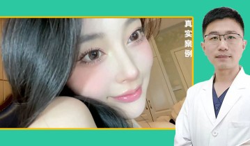 黄金媚眼重睑术效果【2】