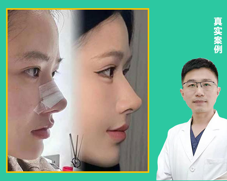 张亚伦医生-肋骨鼻综合即刻视频