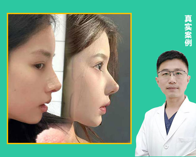 自体肋骨鼻综合即刻效果视频