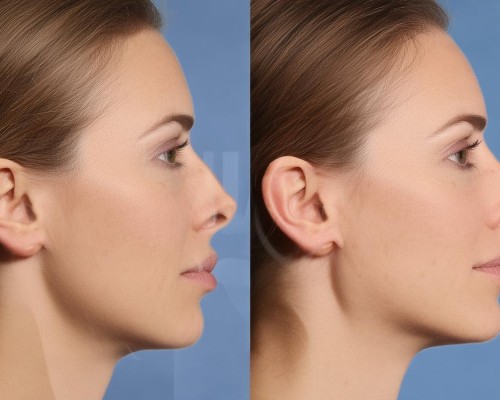 Plastische Nasenchirurgie - die Kunst, die perfekte Nase zu gestalten
